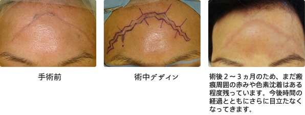 W形成術による瘢痕修正